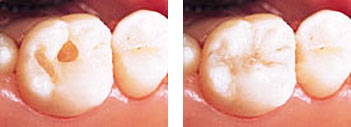 Minimalinvasive Präparation