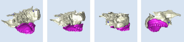 3d Implantatplanung