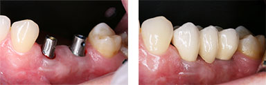 Keramische Brücke auf 2 Implantaten