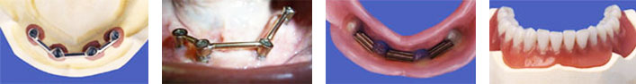 Unterkiefersteg auf 4 Implantaten und Stegprothese