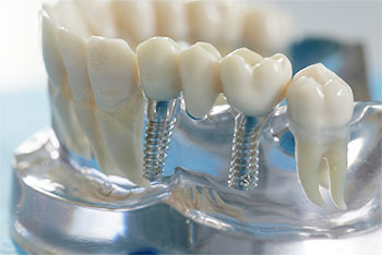 Implantat Nahaufnahme - Dr. Weitze Implantologie Hamburg-Neugraben